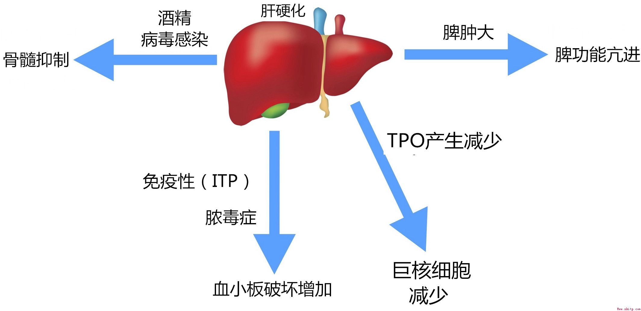肝硬化并发血小板减少的原因和治