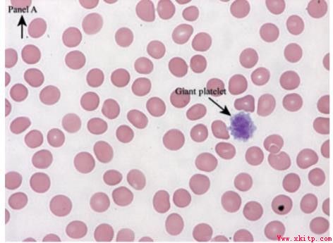 你以为的免疫性血小板减少症